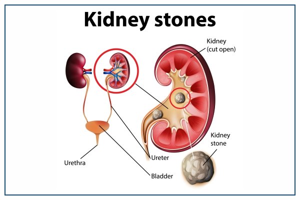 kidney stones